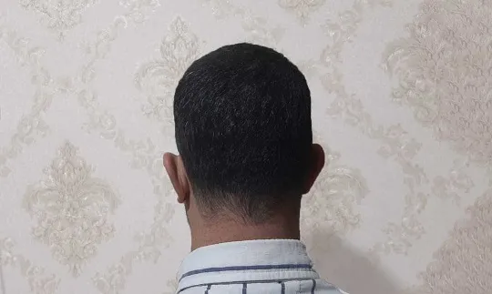 بانک مو چیست و در کجای سر قرار دارد - موارد مهم بانک مو