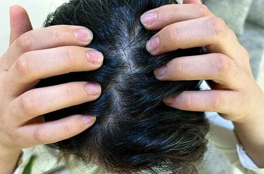 مراحل رشد مو بعد از کاشت مو چگونه است؟