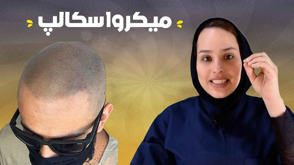 میکرو اسکالپ چیست؟ مزایا و معایب درمان طاسی با اسکالپ سر