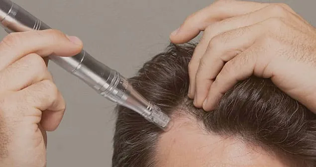 مزونیدلینگ مو چیست؟ بررسی کامل روش مزونیدلینگ
