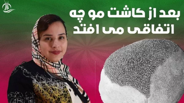 با دلمه های بعد از کاشت مو چگونه برخورد کنیم؟