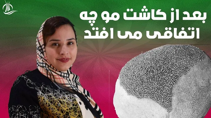 با دلمه های بعد از کاشت مو چگونه برخورد کنیم؟