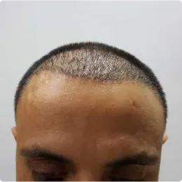 مراحل کاشت مو - سه ماه بعد کاشت