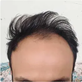 مراحل کاشت مو - قبل کاشت