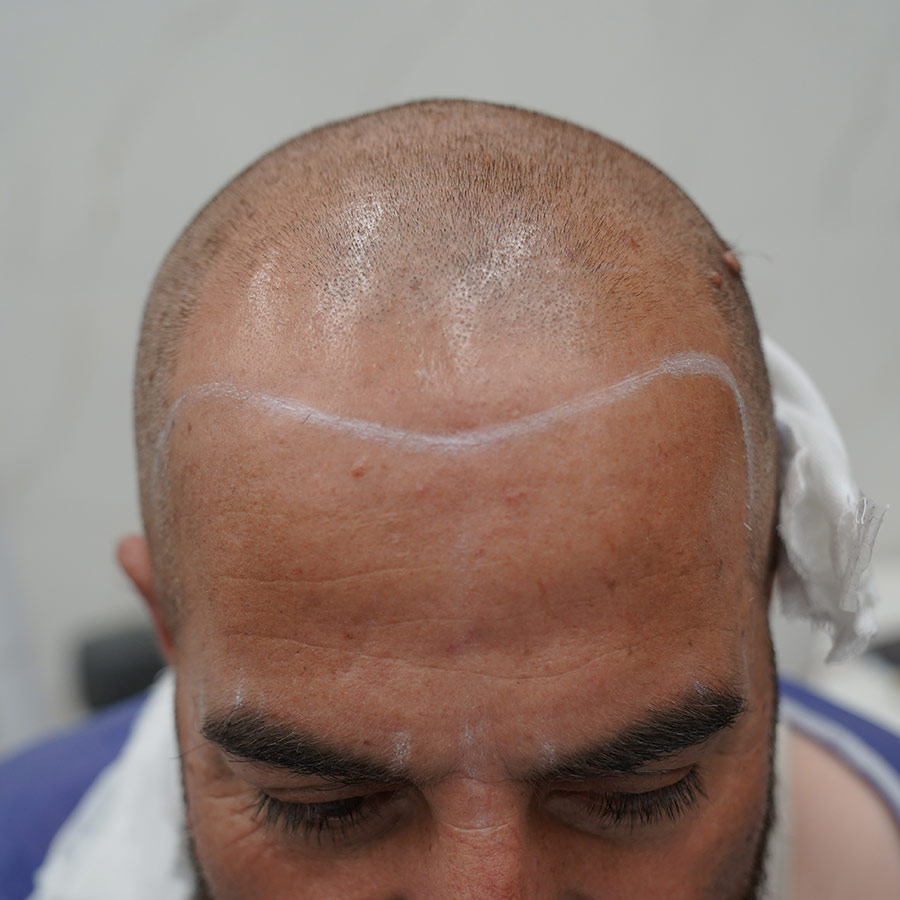طراحی خط رویش مو طبیعی