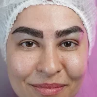 eyebrow transplant model – after 1 بعد از کاشت ابرو