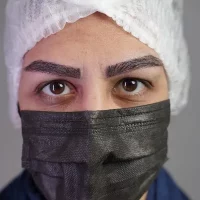 eyebrow transplant model – after 10 بعد از کاشت ابرو
