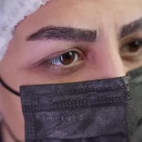 eyebrow transplant model – after 11 بعد از کاشت ابرو
