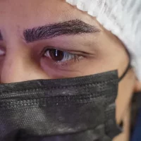 eyebrow transplant model – after 12 بعد از کاشت ابرو