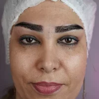 eyebrow transplant model – after 16 بعد از کاشت ابرو