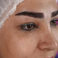 eyebrow transplant model – after 18 بعد از کاشت ابرو
