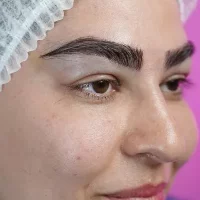 eyebrow transplant model – after 2 بعد از کاشت ابرو