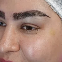eyebrow transplant model – after 3 بعد از کاشت ابرو