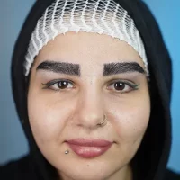 eyebrow transplant model – after 4 بعد از کاشت ابرو