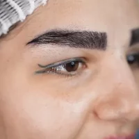 eyebrow transplant model – after 5 بعد از کاشت ابرو