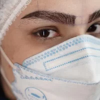 eyebrow transplant model – after 8 بعد از کاشت ابرو
