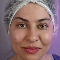 eyebrow transplant model – before 1 قبل از کاشت ابرو