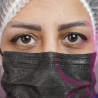eyebrow transplant model – before 10 قبل از کاشت ابرو