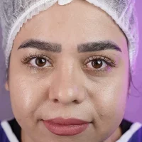 eyebrow transplant model – before 13 قبل از کاشت ابرو