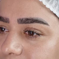 eyebrow transplant model – before 14 قبل از کاشت ابرو