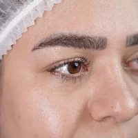 eyebrow transplant model – before 15 قبل از کاشت ابرو