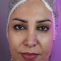 eyebrow transplant model – before 16 قبل از کاشت ابرو