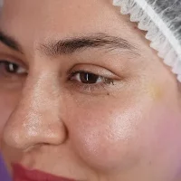 eyebrow transplant model – before 3 قبل از کاشت ابرو