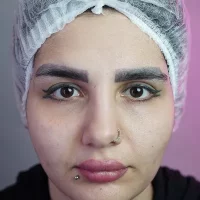 eyebrow transplant model – before 4 قبل از کاشت ابرو