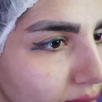 eyebrow transplant model – before 5 قبل از کاشت ابرو